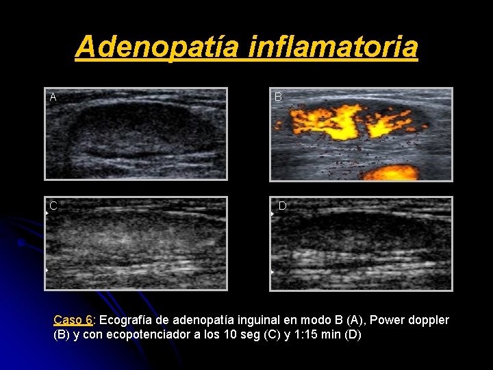 Adenopatía inflamatoria A C B D Caso 6: Ecografía de adenopatía inguinal en modo