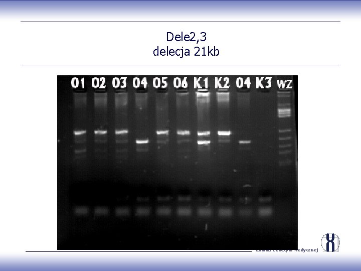 Dele 2, 3 delecja 21 kb Zakład Genetyki Medycznej 