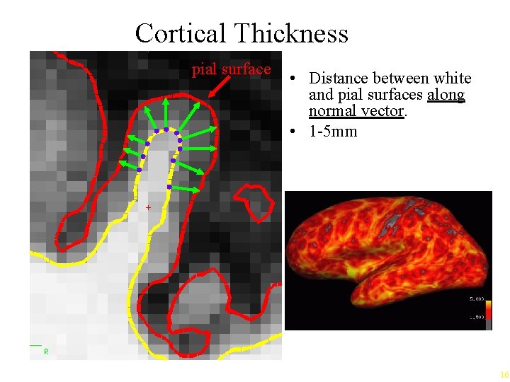 Cortical Thickness pial surface • Distance between white and pial surfaces along normal vector.