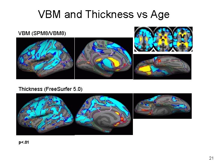 VBM and Thickness vs Age VBM (SPM 8/VBM 8) Thickness (Free. Surfer 5. 0)