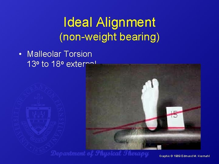 Ideal Alignment (non-weight bearing) • Malleolar Torsion 13 o to 18 o external Graphic