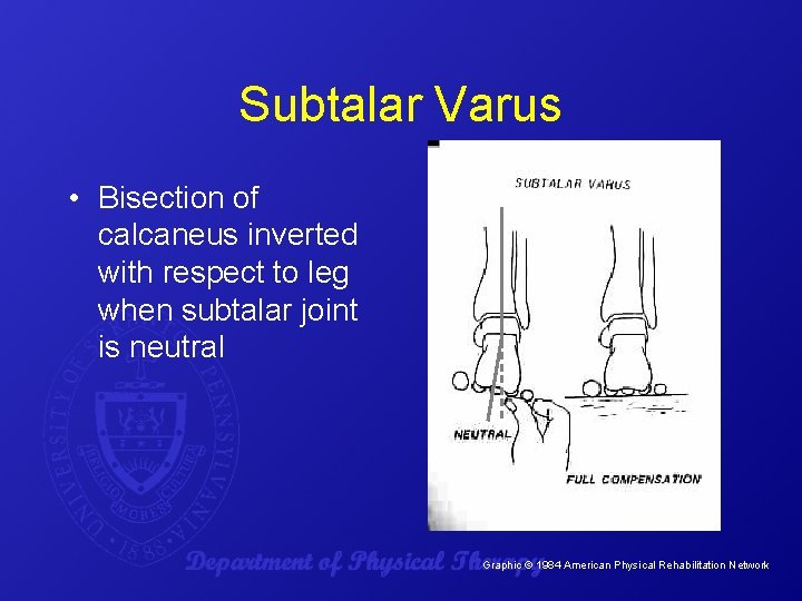 Subtalar Varus • Bisection of calcaneus inverted with respect to leg when subtalar joint