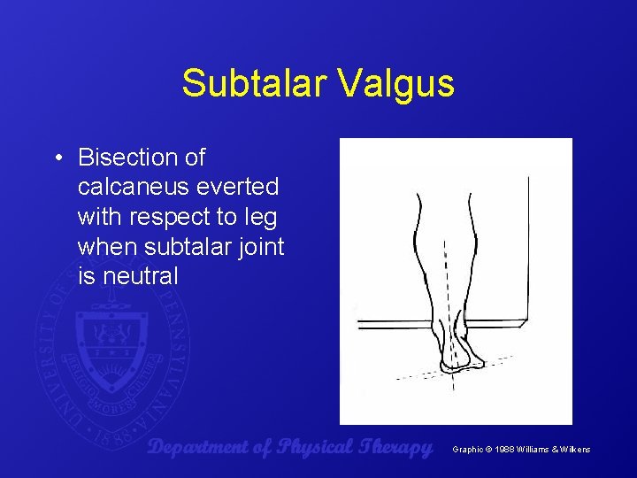 Subtalar Valgus • Bisection of calcaneus everted with respect to leg when subtalar joint