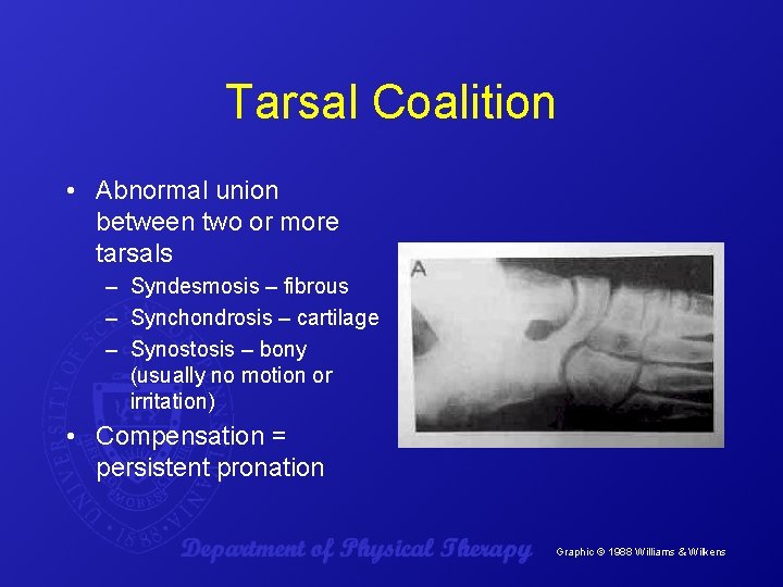 Tarsal Coalition • Abnormal union between two or more tarsals – Syndesmosis – fibrous