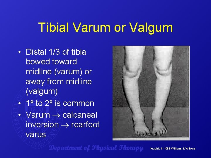 Tibial Varum or Valgum • Distal 1/3 of tibia bowed toward midline (varum) or