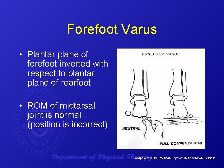 Forefoot Varus • Plantar plane of forefoot inverted with respect to plantar plane of