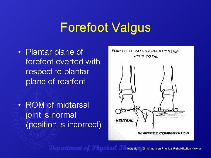 Forefoot Valgus • Plantar plane of forefoot everted with respect to plantar plane of
