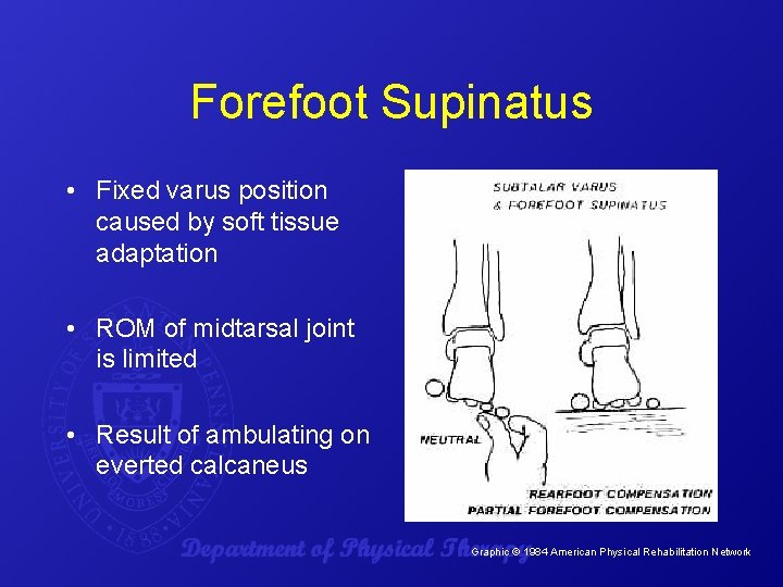 Forefoot Supinatus • Fixed varus position caused by soft tissue adaptation • ROM of
