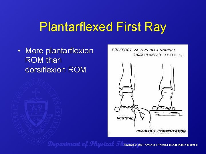 Plantarflexed First Ray • More plantarflexion ROM than dorsiflexion ROM Graphic © 1984 American