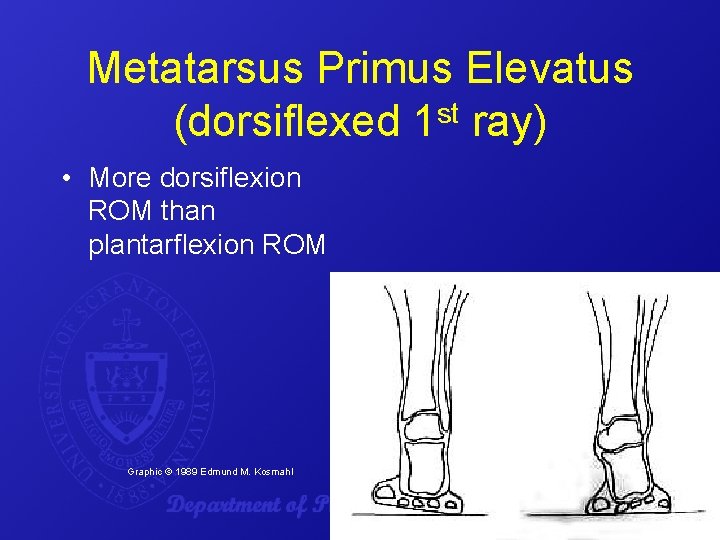 Metatarsus Primus Elevatus (dorsiflexed 1 st ray) • More dorsiflexion ROM than plantarflexion ROM