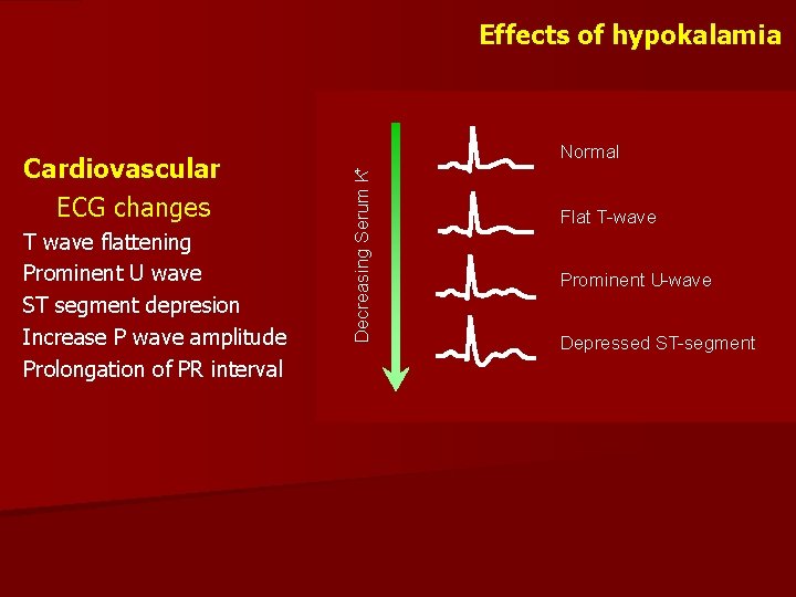 Effects of hypokalamia T wave flattening Prominent U wave ST segment depresion Increase P