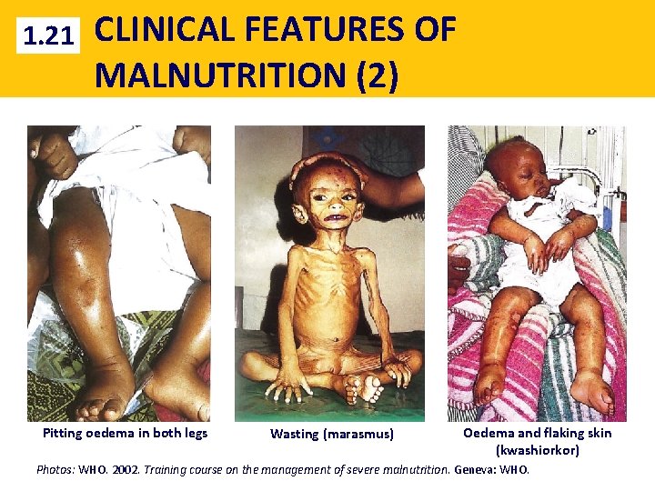 1. 21 CLINICAL FEATURES OF MALNUTRITION (2) Pitting oedema in both legs Wasting (marasmus)