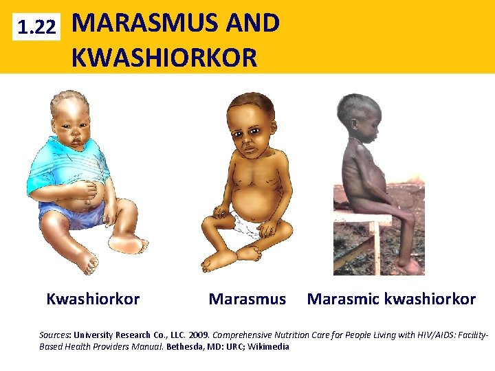 1. 22 MARASMUS AND KWASHIORKOR Kwashiorkor Marasmus Marasmic kwashiorkor Sources: University Research Co. ,