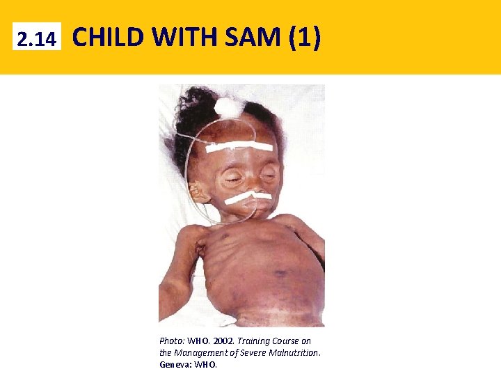 2. 14 CHILD WITH SAM (1) Photo: WHO. 2002. Training Course on the Management