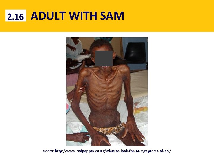 2. 16 ADULT WITH SAM Photo: http: //www. redpepper. co. ug/what-to-look-for-14 -symptoms-of-hiv/ 