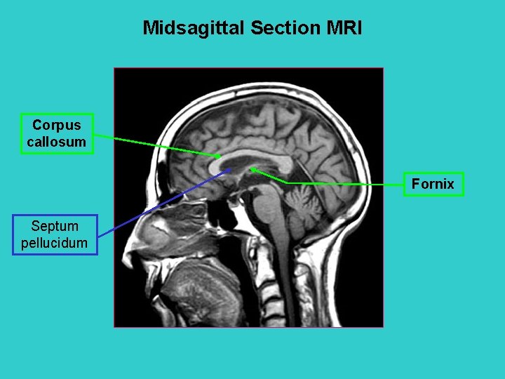 Midsagittal Section MRI Corpus callosum Fornix Septum pellucidum 