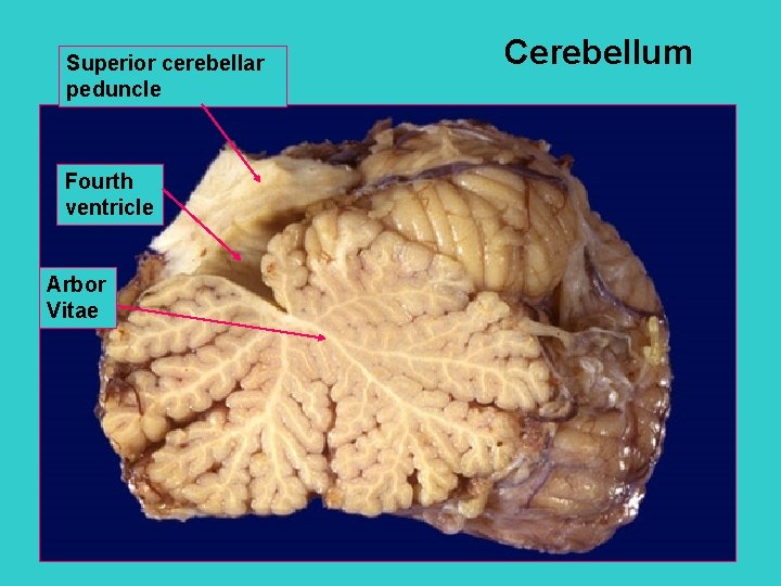 Superior cerebellar peduncle Fourth ventricle Arbor Vitae Cerebellum 