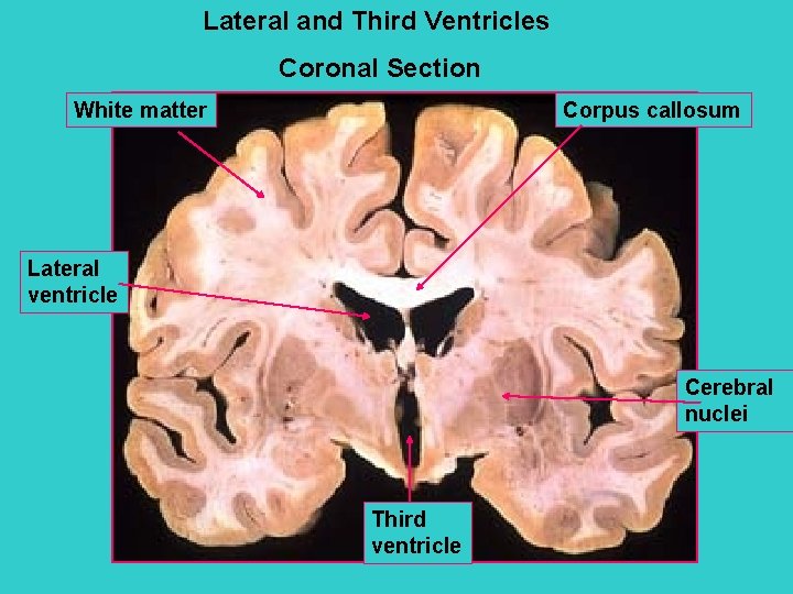 Lateral and Third Ventricles Coronal Section White matter Corpus callosum Lateral ventricle Cerebral nuclei