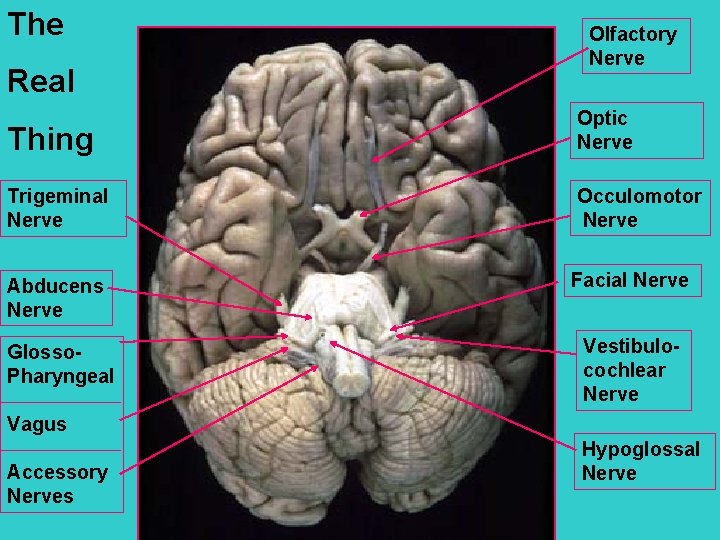 The Real Olfactory Nerve Thing Optic Nerve Trigeminal Nerve Occulomotor Nerve Abducens Nerve Facial