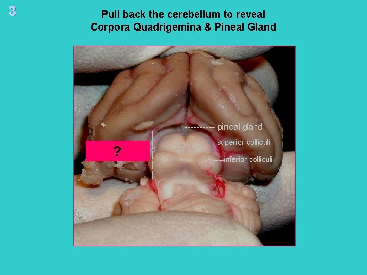 3 Pull back the cerebellum to reveal Corpora Quadrigemina & Pineal Gland ? 