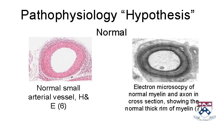 Pathophysiology “Hypothesis” Normal small arterial vessel, H& E (6) Electron microsocpy of normal myelin