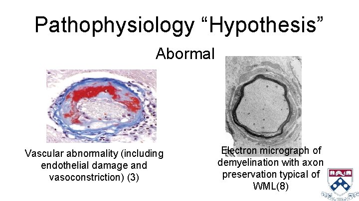 Pathophysiology “Hypothesis” Abormal Vascular abnormality (including endothelial damage and vasoconstriction) (3) Electron micrograph of