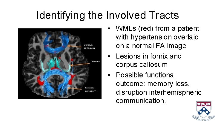 Identifying the Involved Tracts • WMLs (red) from a patient with hypertension overlaid on