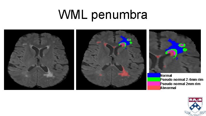 WML penumbra Normal Pseudo normal 2 -4 mm rim Pseudo normal 2 mm rim