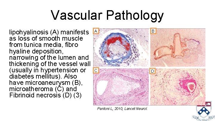 Vascular Pathology lipohyalinosis (A) manifests A as loss of smooth muscle from tunica media,