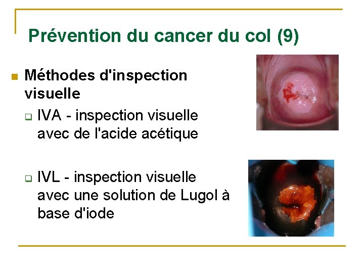  Prévention du cancer du col (9) n Méthodes d'inspection visuelle q IVA -