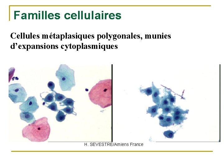 Familles cellulaires Cellules métaplasiques polygonales, munies d’expansions cytoplasmiques H. SEVESTRE/Amiens France 