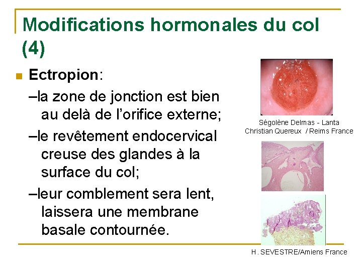 Modifications hormonales du col (4) n Ectropion: –la zone de jonction est bien au