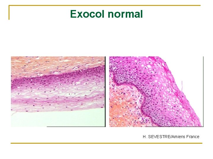 Exocol normal H. SEVESTRE/Amiens France 