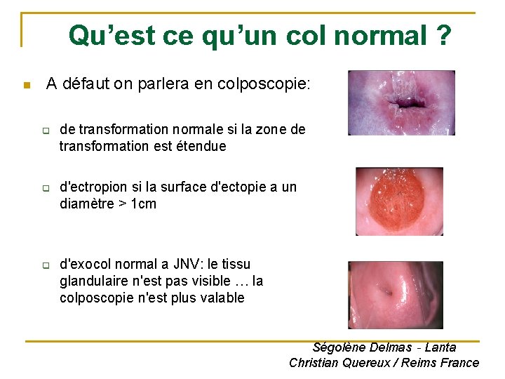 Qu’est ce qu’un col normal ? n A défaut on parlera en colposcopie: q