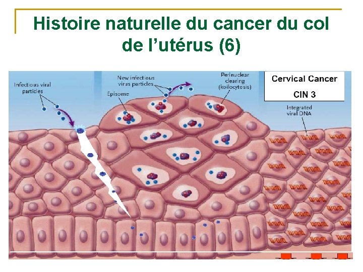 Histoire naturelle du cancer du col de l’utérus (6) 