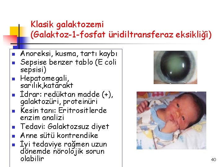 Klasik galaktozemi (Galaktoz-1 -fosfat üridiltransferaz eksikliği) Anoreksi, kusma, tartı kaybı Sepsise benzer tablo (E