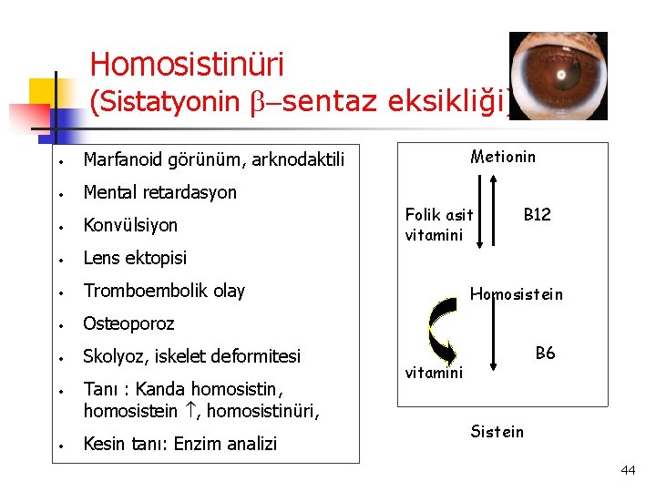 Homosistinüri (Sistatyonin -sentaz eksikliği) • Marfanoid görünüm, arknodaktili • Mental retardasyon • Konvülsiyon •