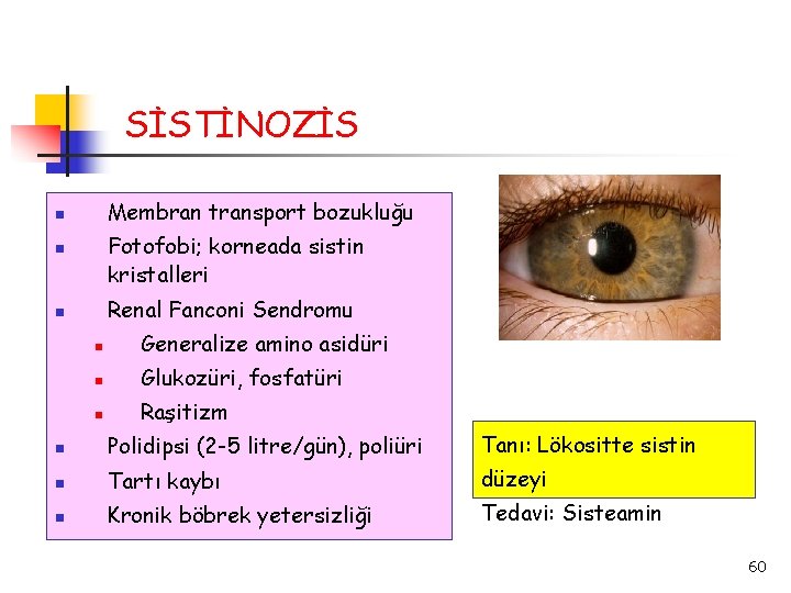 SİSTİNOZİS Membran transport bozukluğu Fotofobi; korneada sistin kristalleri Renal Fanconi Sendromu Generalize amino asidüri