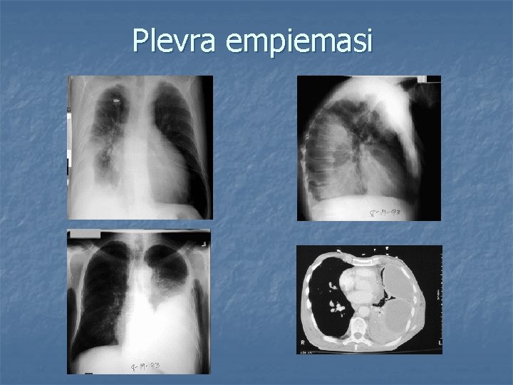 Plevra empiemasi 