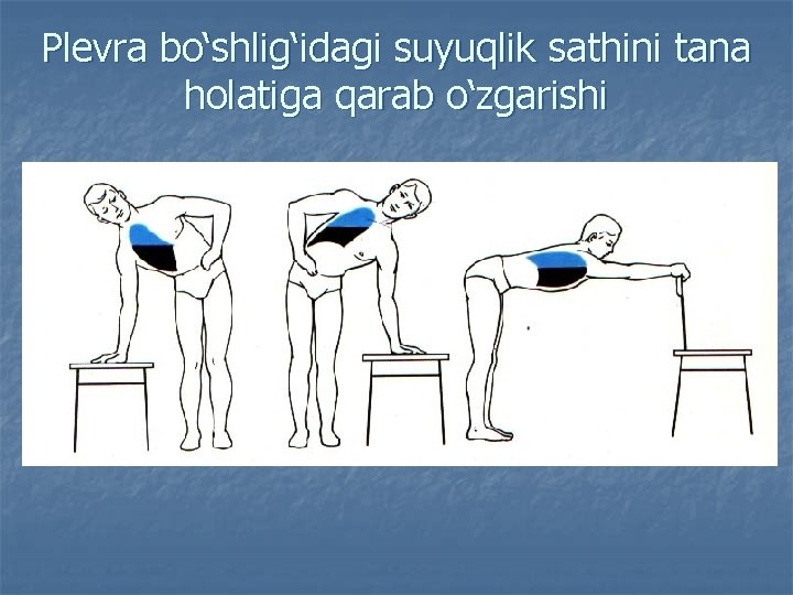 Plevra bo‘shlig‘idagi suyuqlik sathini tana holatiga qarab o‘zgarishi 