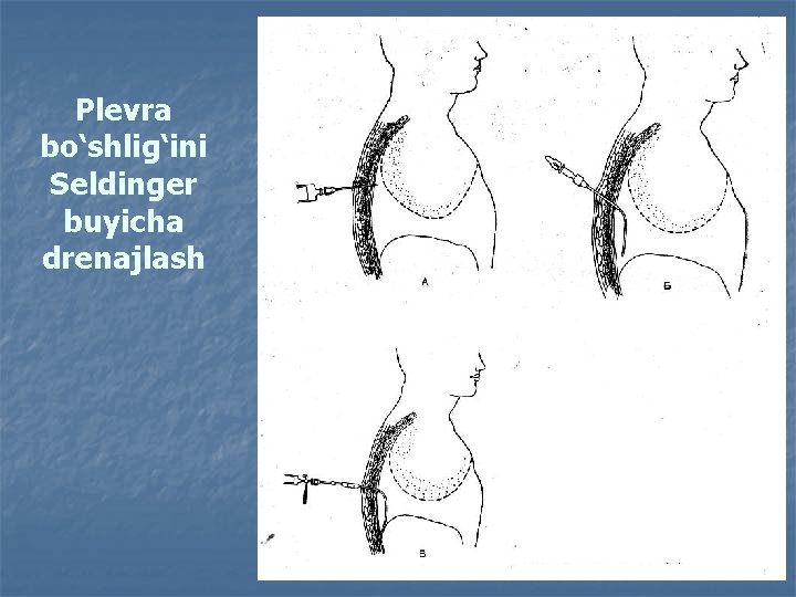 Plevra bo‘shlig‘ini Seldinger buyicha drenajlash 