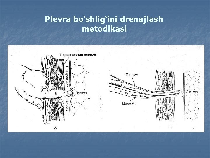 Plevra bo‘shlig‘ini drenajlash metodikasi 