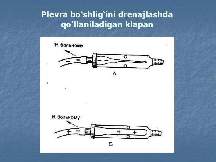 Plevra bo‘shlig‘ini drenajlashda qo‘llaniladigan klapan 