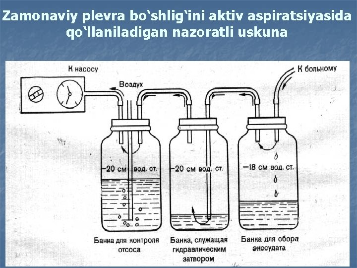 Zamonaviy plevra bo‘shlig‘ini aktiv aspiratsiyasida qo‘llaniladigan nazoratli uskuna 
