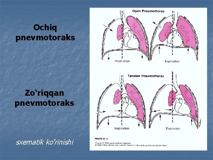 Ochiq pnevmotoraks Zo‘riqqan pnevmotoraks sxematik ko‘rinishi 