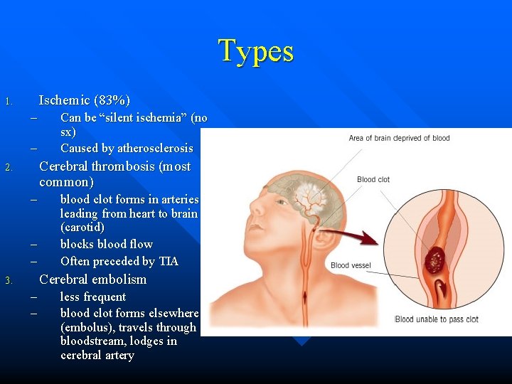 Types Ischemic (83%) 1. – – Can be “silent ischemia” (no sx) Caused by