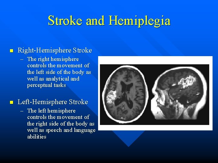 Stroke and Hemiplegia n Right-Hemisphere Stroke – The right hemisphere controls the movement of