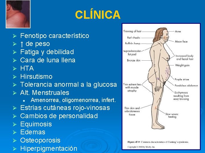 CLÍNICA Ø Ø Ø Ø Fenotipo característico ↑ de peso Fatiga y debilidad Cara