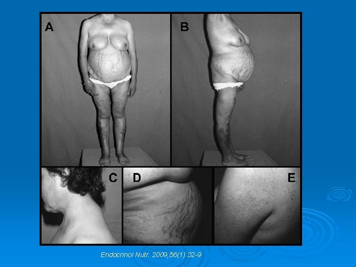 Endocrinol Nutr. 2009; 56(1): 32 -9 