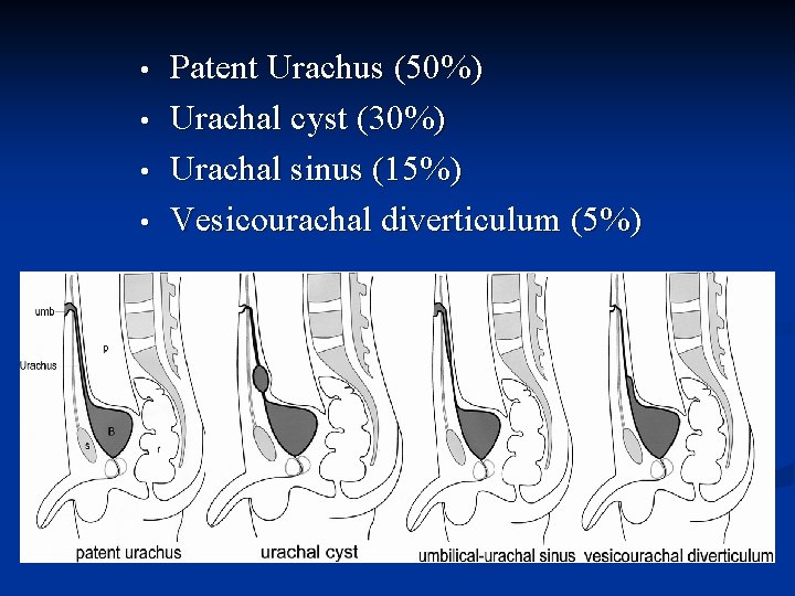  • • Patent Urachus (50%) Urachal cyst (30%) Urachal sinus (15%) Vesicourachal diverticulum